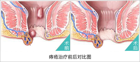 美国PPH微创治疗技术图片