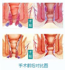 内痔术前与术后对比图