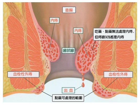 痔疮