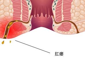 开始仅限于局部的炎症,这时若未能及时治疗,炎症即可以向肛门周围蔓延